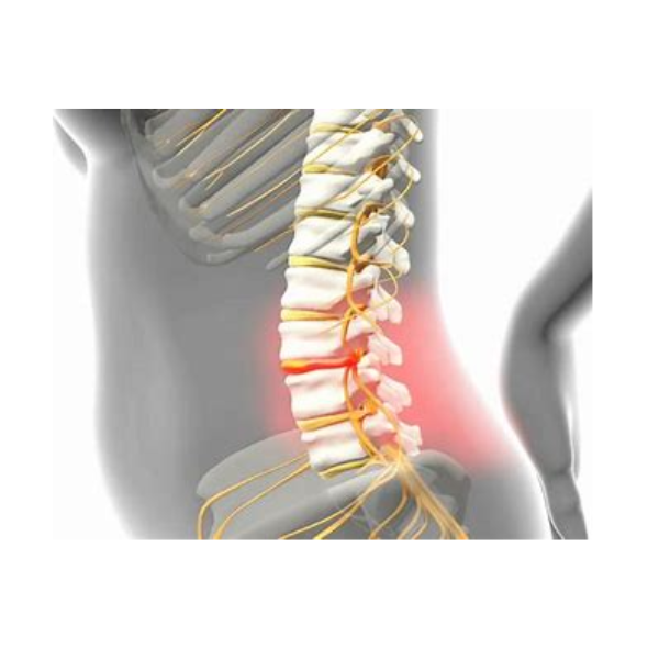 Hernia de disco, compressão da raiz nervosa